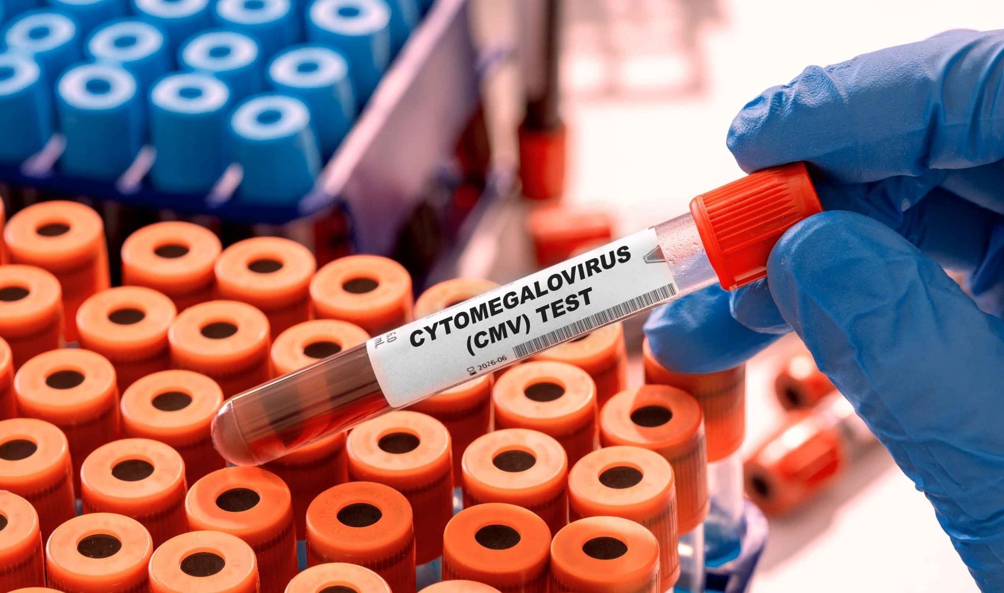 Cytomegalovírusová infekcia: sprievodca
