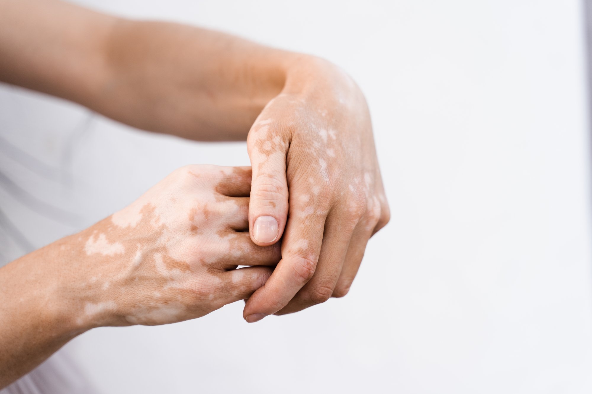 Vitiligo: čo by ste mali vedieť